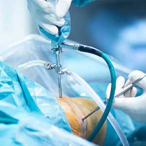 Arthroscopy